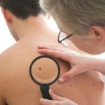 How to spot a mole that needs treatment